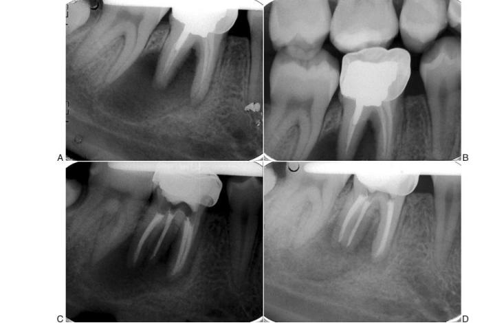 RCT, Befor & after